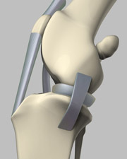 With the help of a $3.1 million grant, researchers will expand their biological joint technology that uses living tissue instead of plastic or metal to replace damaged joints.