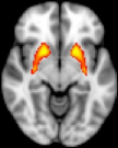 Dysfunction in a subcortical brain region, the striatum, which is associated with psychosis risk. Credit: John Kerns